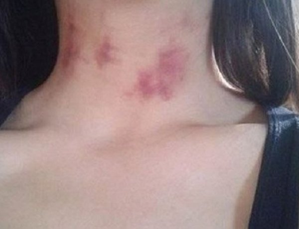 تعرف على سبب البقع الحمراء التي تظهر مباشرة ما بعد العلاقة بين الرجل و المرأة